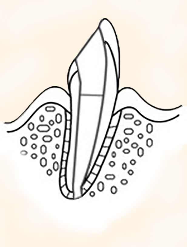 Endodontie Wurzelbehandlung aufgebauter Zahn